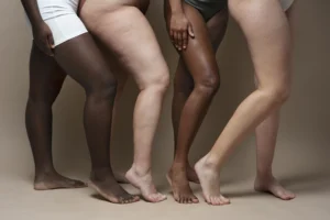 celulities vs lipedema